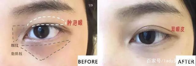 双眼皮上长了个脂肪粒