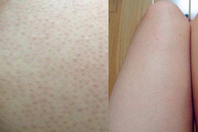 长的痘痘疼是什么原因