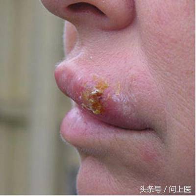 下嘴唇张痘痘是怎么回事呢
