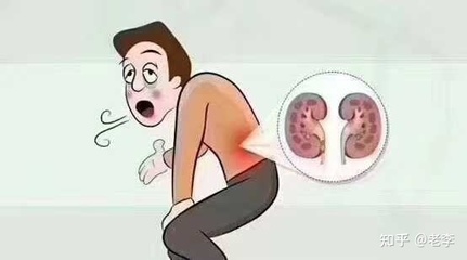 肾虚咳嗽