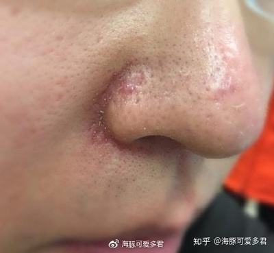 酒糟鼻子怎么治疗效果好
