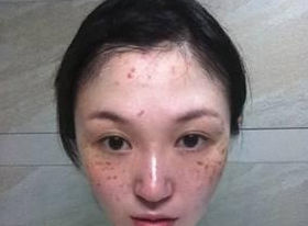 鼻子痘痘好了留下红印