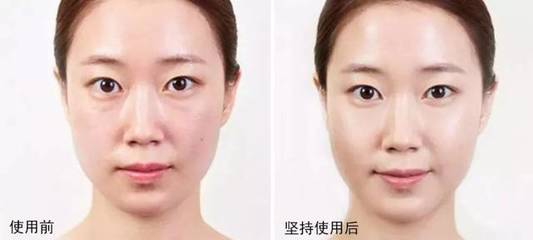 痘痘肌用什么喷雾