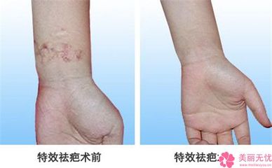 疤痕软化针的价格