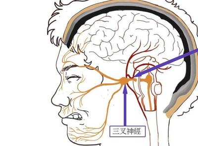 三叉神经疼是怎么回事