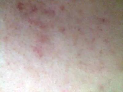 脸上好多痘印痘痘可以用维e吗