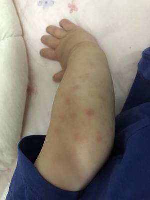 10个月宝宝过敏起红疹