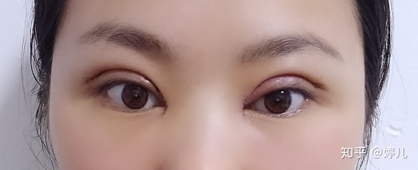 全切双眼皮恢复过程