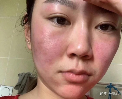 痘痘该不该挤