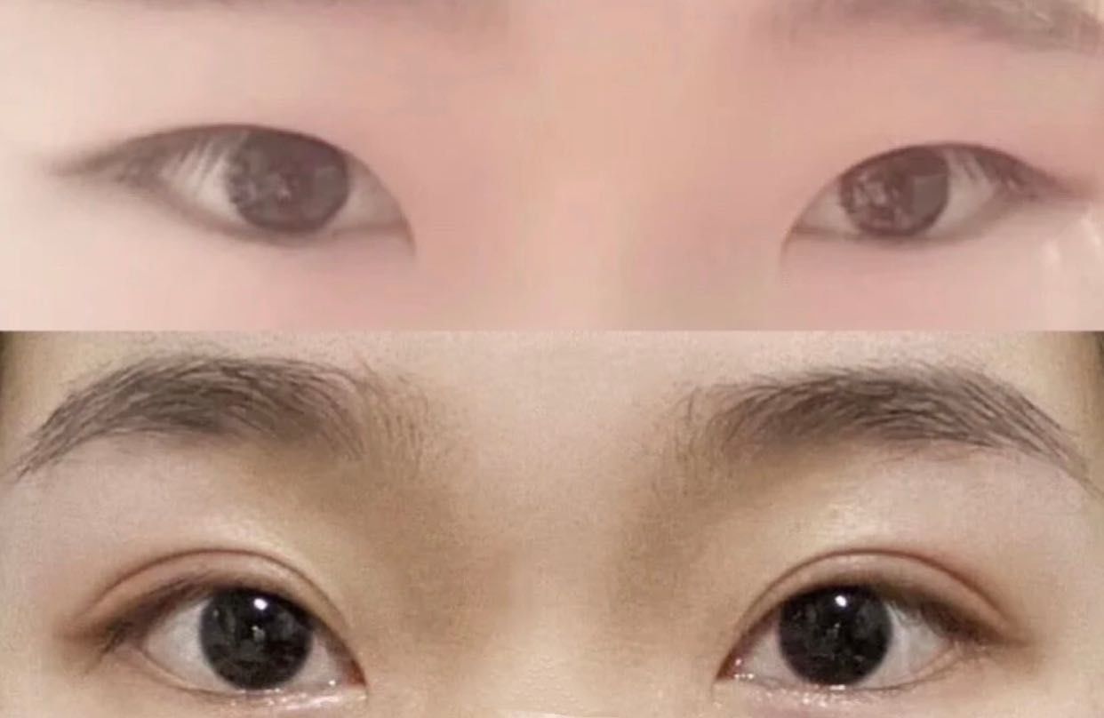 哪做双眼皮好