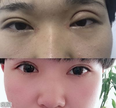 双眼皮会失败吗