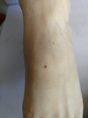 脚上有血斑是怎么回事