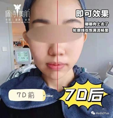 脸轮廓线上长痘痘