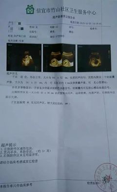 胎儿智障能检查出来吗