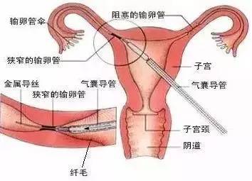 输卵管不通是怎么回事