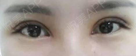 双眼皮割的太窄了