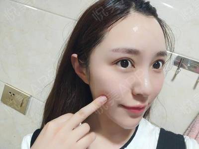 开眼角拆线后多久化妆
