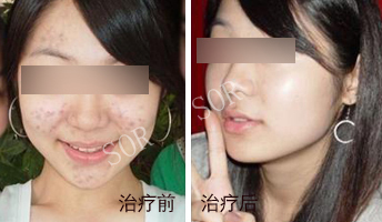 哪儿看痘痘好