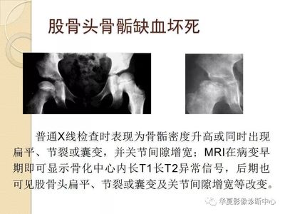 股骨头囊变是怎么回事