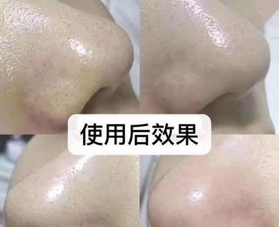 冬天鼻子里痘痘