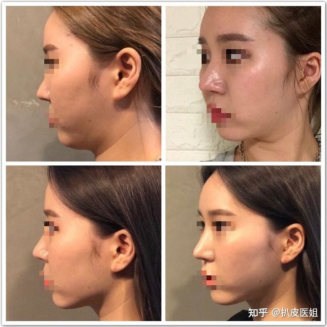 哪抽脂比较好