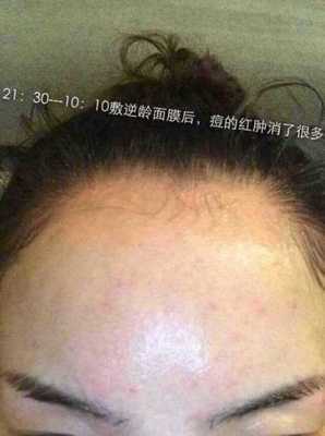 脸上红肿痘痘痘印