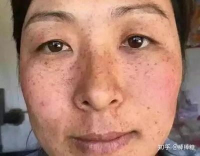 脸上突然长斑是怎么回事