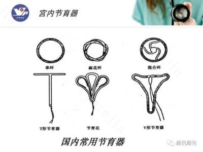 上环为什么会怀孕