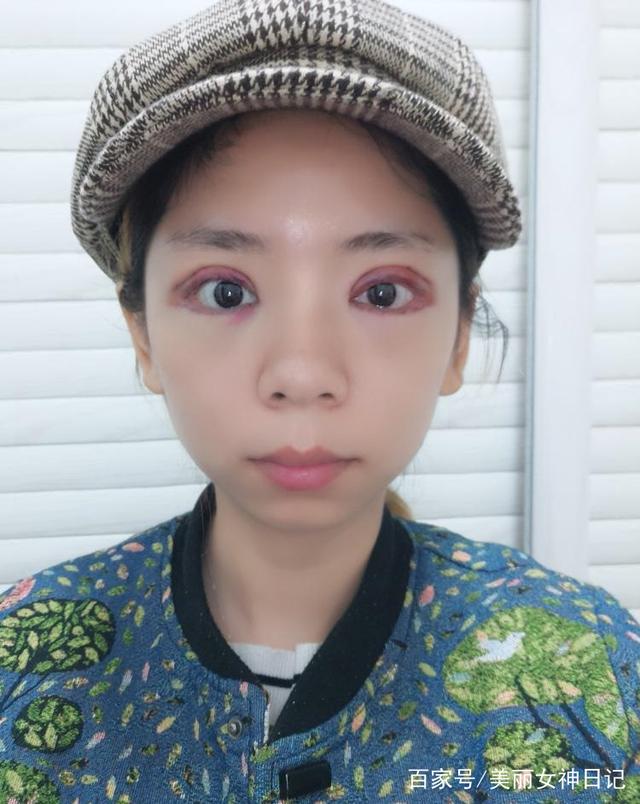 做全切双眼皮多久能化妆