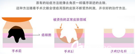 激光祛痣原理