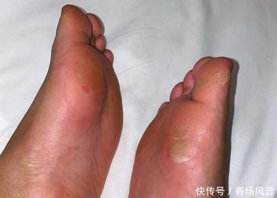 脚板烂了是怎么回事