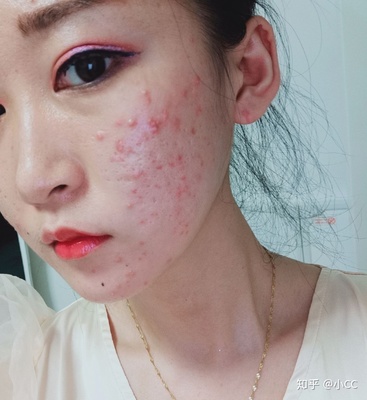 长痘痘去看皮肤科