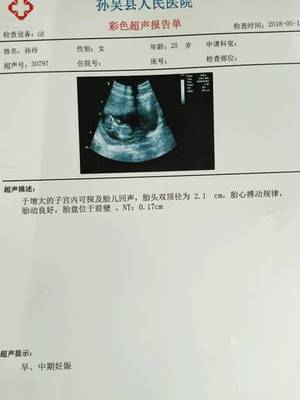 胎儿畸形能检查出来吗