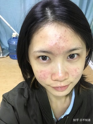 如何把痘痘皮肤养好