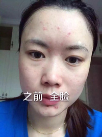 脸上有痘痘适合什么精华