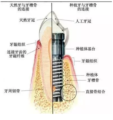 种牙的原理