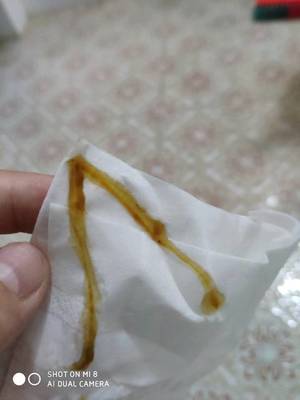 白带有腥味是怎么回事