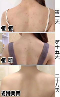 消除背部痘印