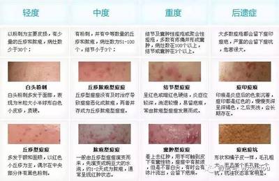 丘疹型痘痘自然好吗