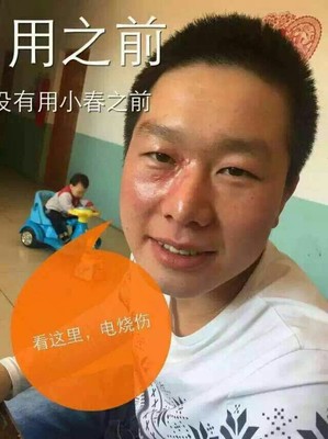 电烧伤疤痕