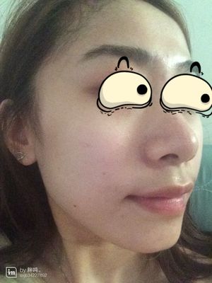 脸上有痘痘不挤会怎样