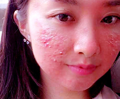 激素脸爆痘痘怎么消炎