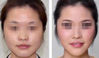 瘦脸针可以打四次吗