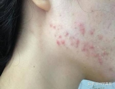 下巴和后脖子长痘痘