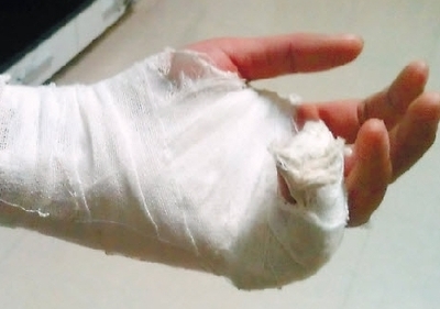 梦见自己手指断了一截