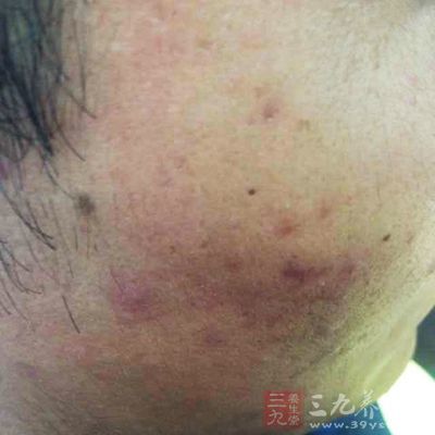 有脓头的痘痘叫什么