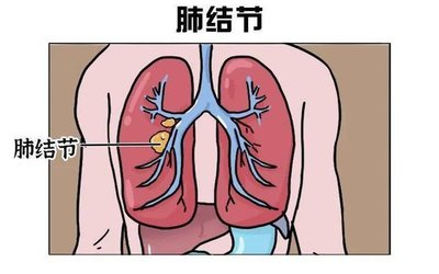 肺结节是怎么回事
