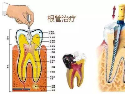 残髓炎怎么治疗