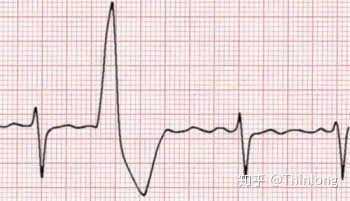 早搏咳嗽