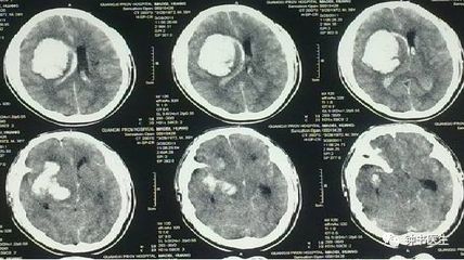 蛛网膜下腔少量出血怎么治疗